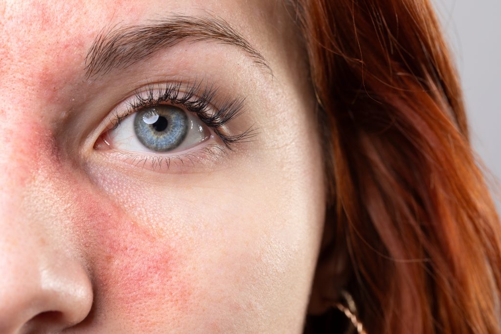 Close-up of woman's face showing red, inflamed skin characteristic of rosacea
