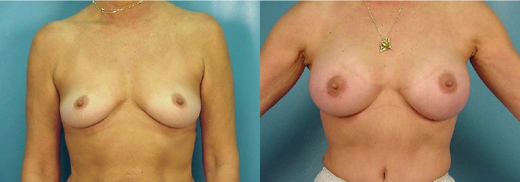 breast1