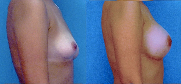 breast11