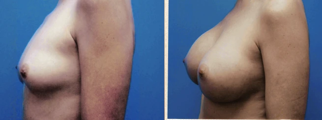 breast18