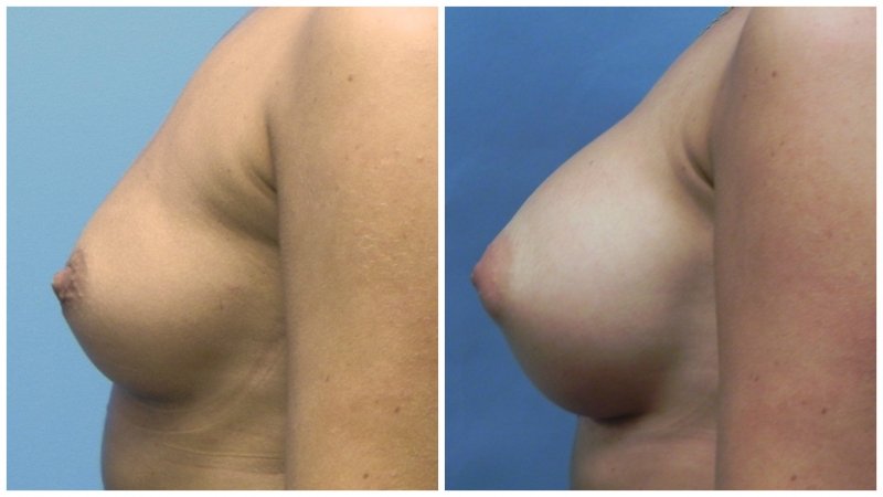 breast26