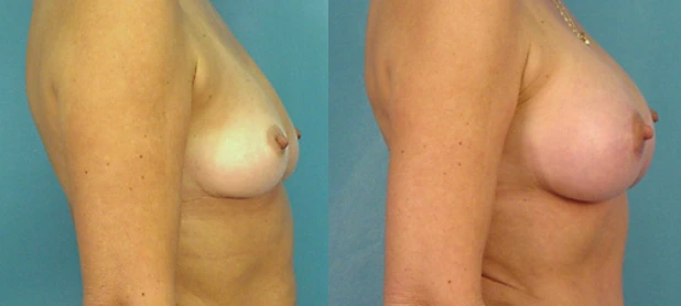 breast3