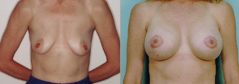 breast4