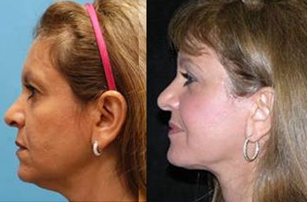 facejuv11