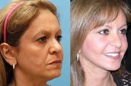 facejuv12