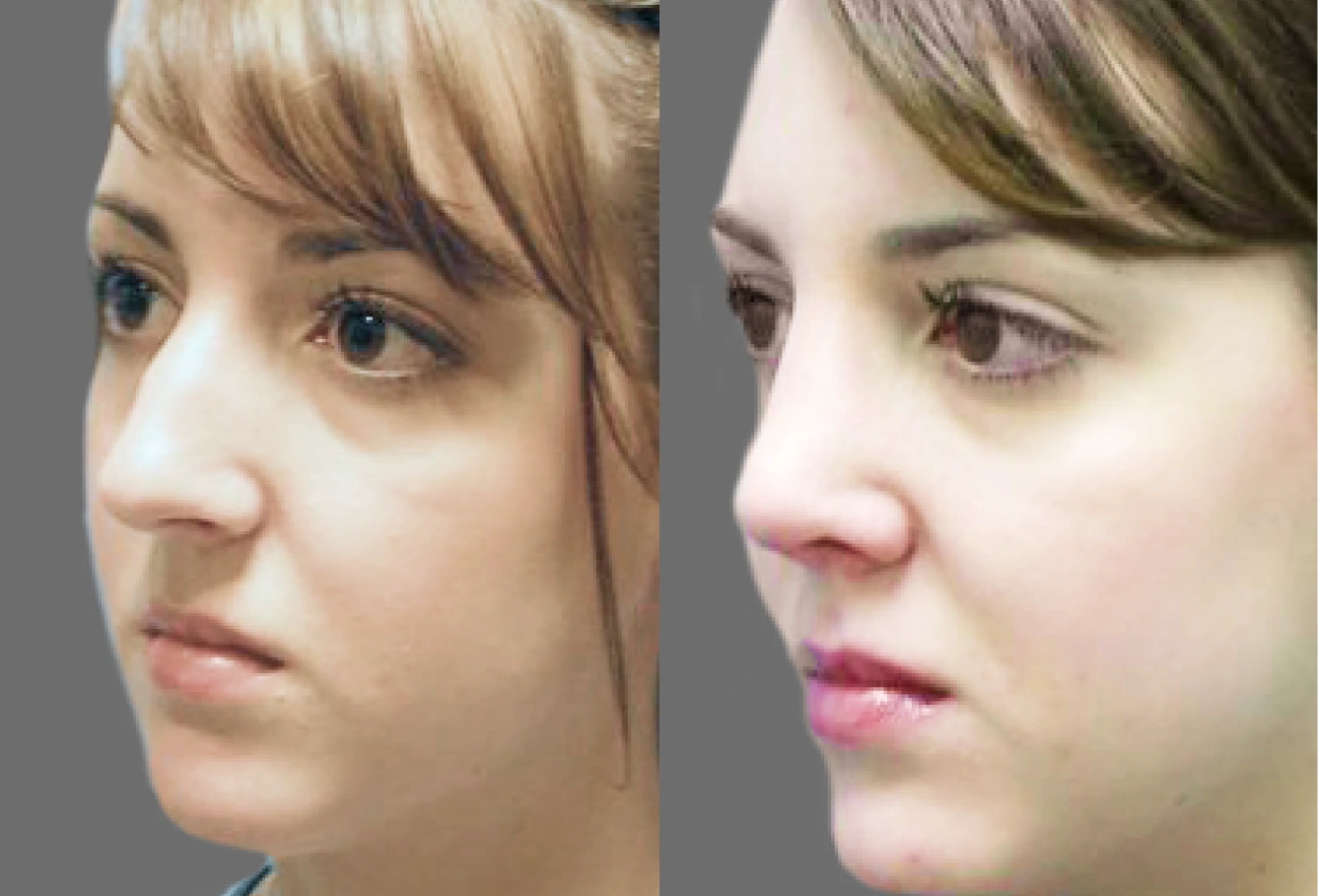 Before and after nose profile showing reduced projection and refined tip