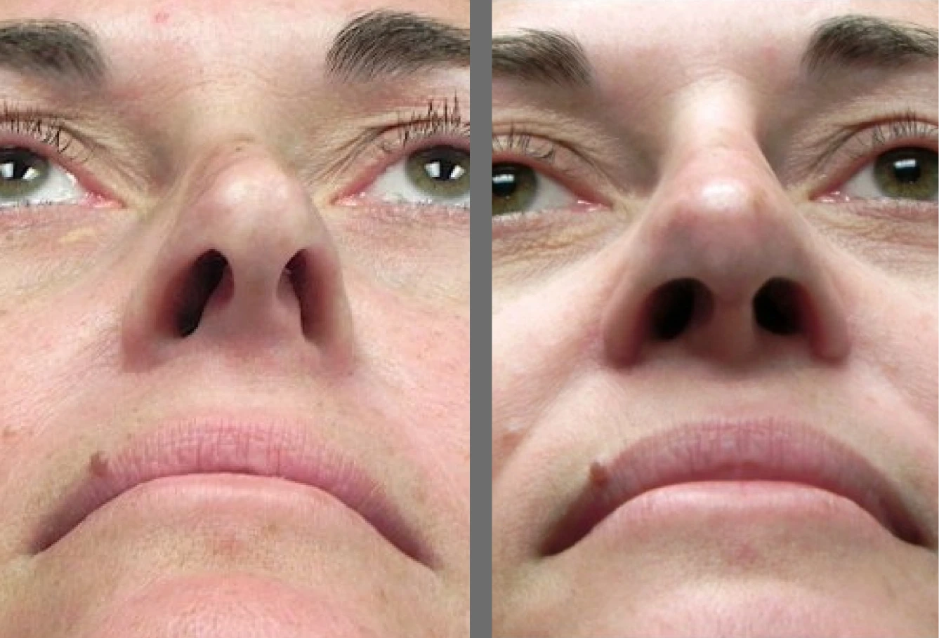 Before and after nose bridge and nostril refinement, frontal view