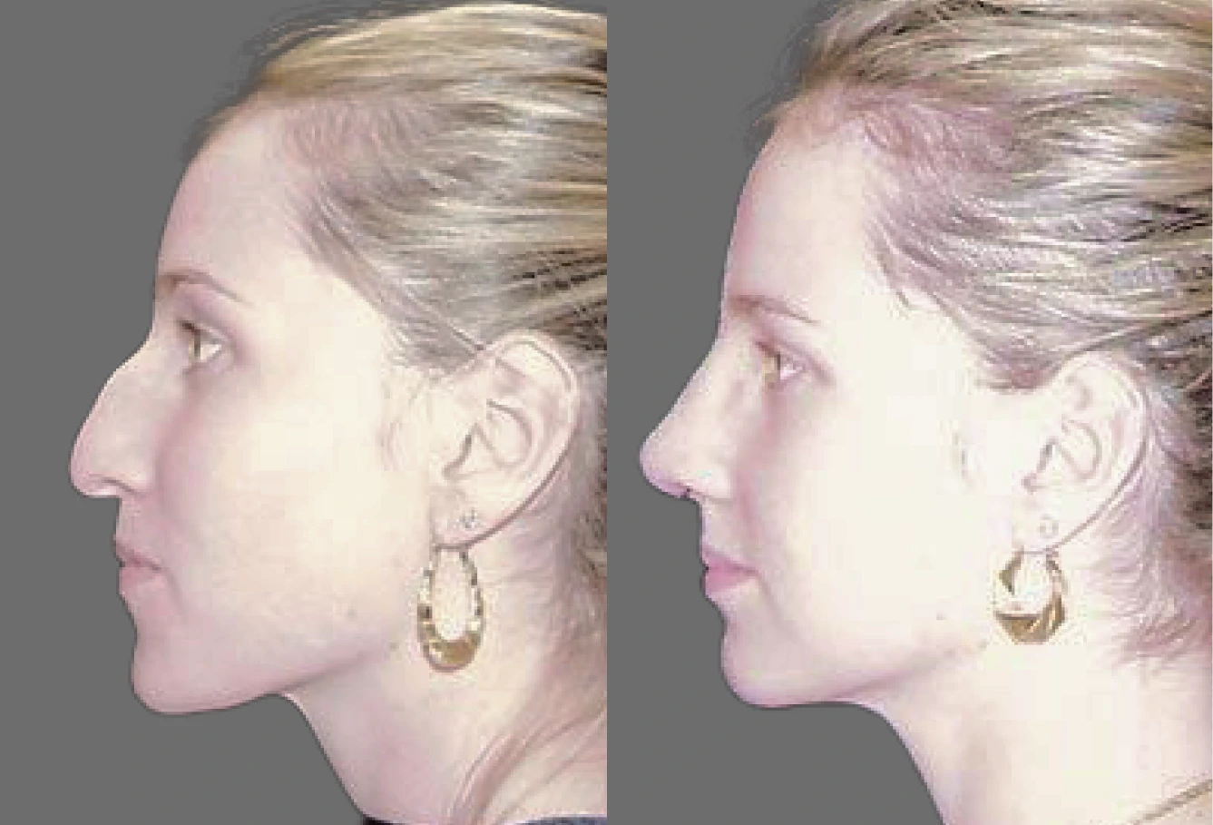 Before and after side profile showing woman's facial refinement and jawline definition