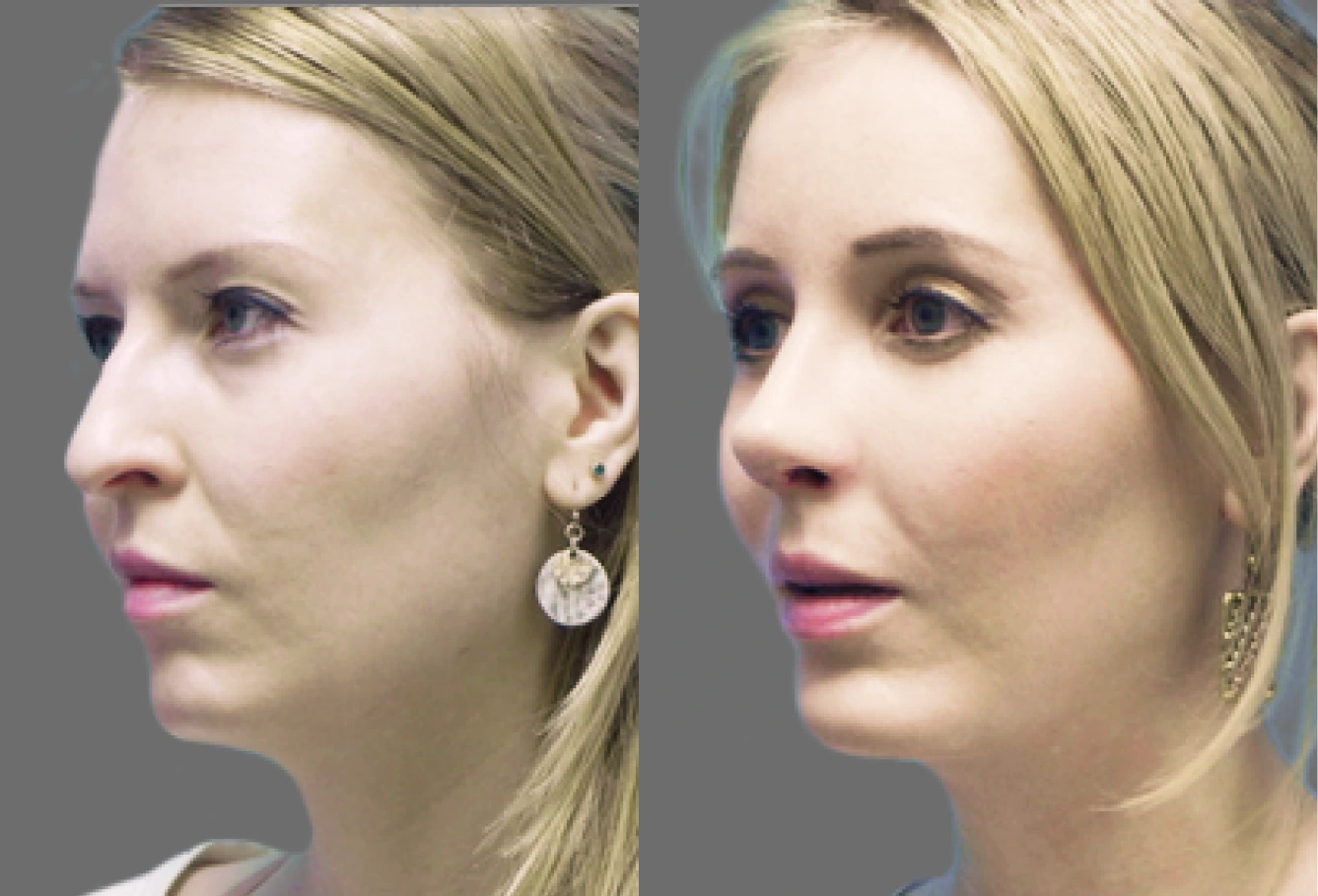 Before and after profile comparison showing woman's facial contour improvement