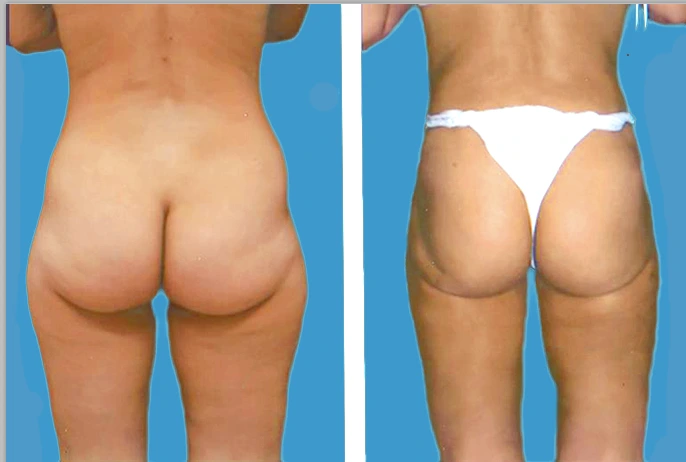 lipo10
