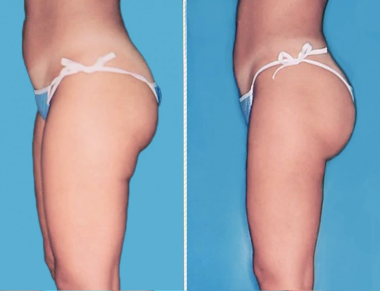 lipo2