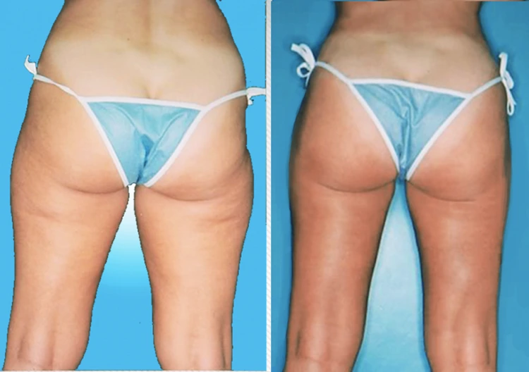 lipo3