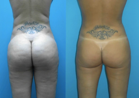 lipo6