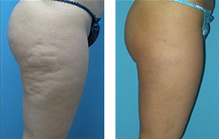 lipo8