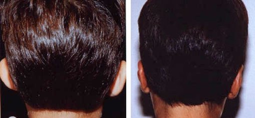 otoplasty4
