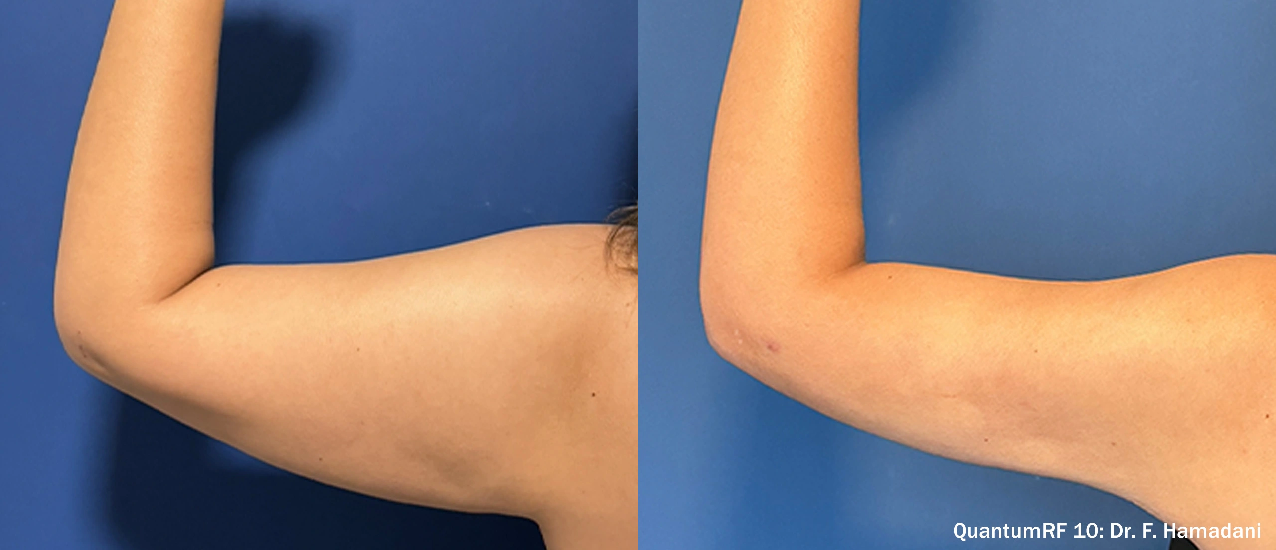 FH_QuantumRF_Arms_Female_LArm_Back_TM