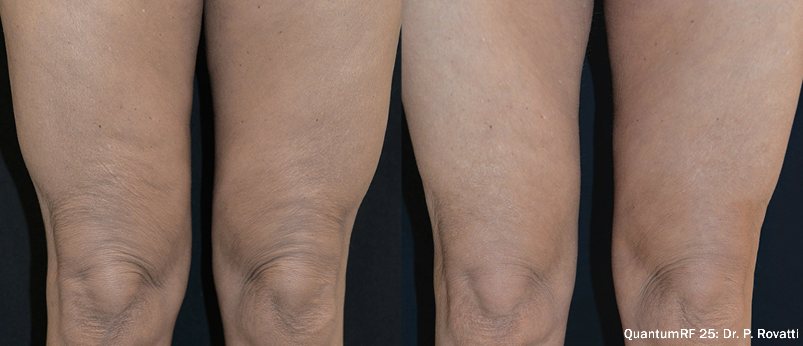 PR_QuantumRF_25_Thighs_Female_Front_TM