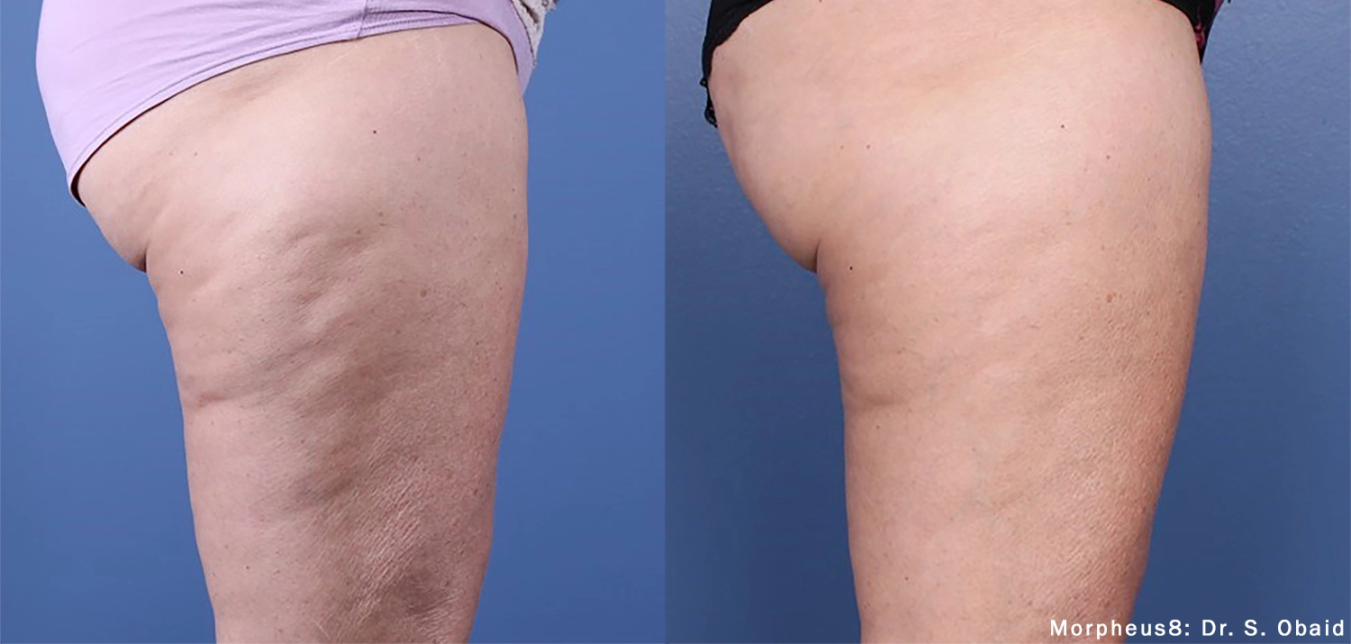 morpheus8-before-after-dr-s-obaid-preview-2