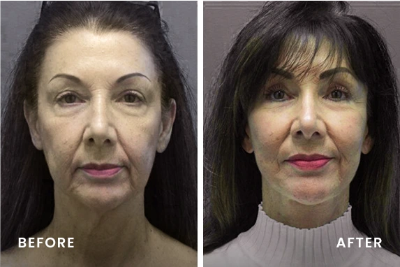 Before and after facial comparison labeled with Before on left and After on right