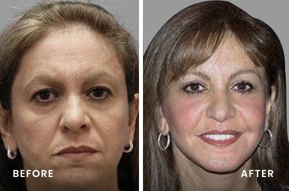 Before and after facial comparison labeled with Before on left and After on right