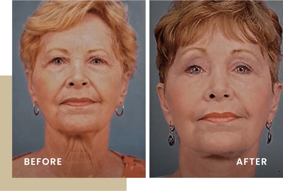 Woman's face before and after facial rejuvenation treatment showing improved skin texture and reduced wrinkles