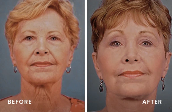 Before and after facial rejuvenation showing reduced wrinkles and improved skin texture