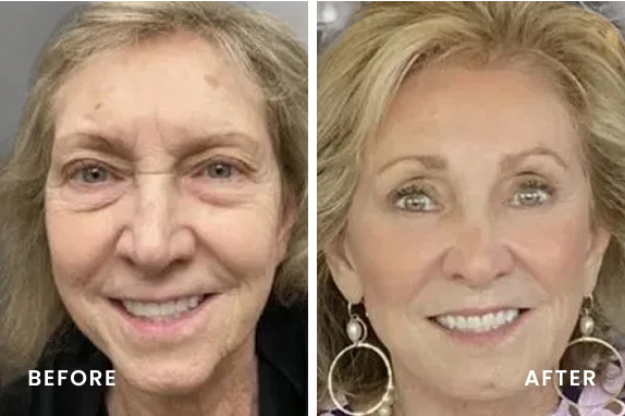 Before and after smile makeover showing reduced under-eye puffiness and brighter smile