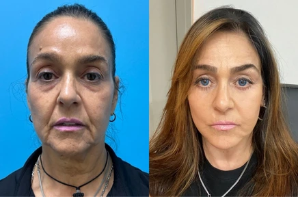 Before and after facial comparison showing a woman's face from frontal view