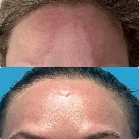 Before and After