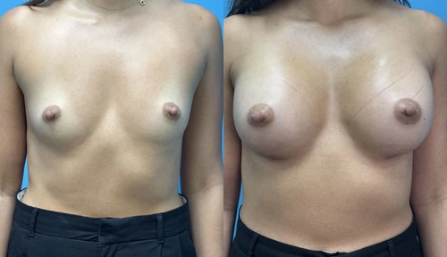 Before and After