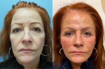 Before and after facial comparison showing a woman's face from frontal view