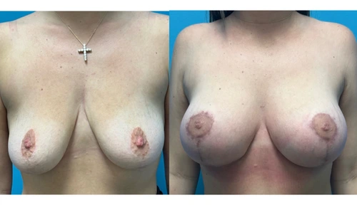 Before and after breast augmentation photos showing increased volume and lift