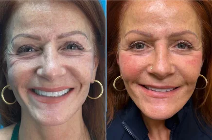 Before and after facial photos of woman smiling, showing skin texture and wrinkle improvement