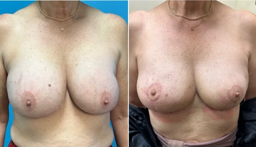 Before and after breast surgery results showing frontal view