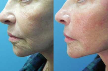 Before and after profile photos showing facial rejuvenation results
