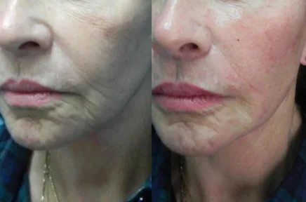 Before and after profile photos showing facial rejuvenation results