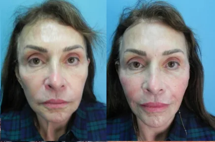 Before and after facial treatment showing improved skin texture and facial contours