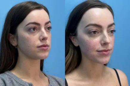 Three-quarter view before and after comparison of woman's facial profile and chin definition