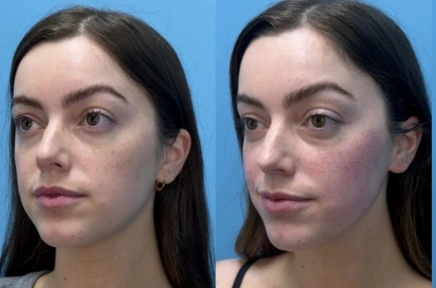 Front-facing before and after comparison of woman's facial balance and symmetry