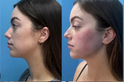 Side-by-side profile comparison showing patient's face before and after treatment