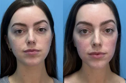 Front-facing before and after comparison of patient's facial appearance