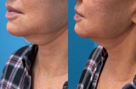 Before and after side profile showing improved jawline and chin definition