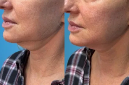 Before and after side profile showing enhanced facial contours and chin projection