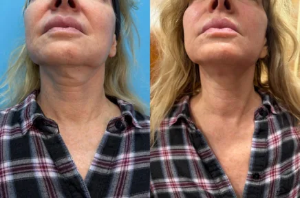 Before and after front view showing improved facial symmetry and lower face definition