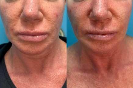 Before and after front view showing reduced neck laxity and improved jawline