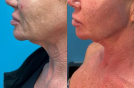Before and after side profile showing improved neck skin tightness and jaw definition