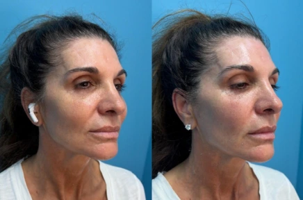 Side-by-side profile comparison of woman's face showing before and after aesthetic treatment