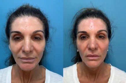 Front-facing before and after comparison of woman's facial appearance