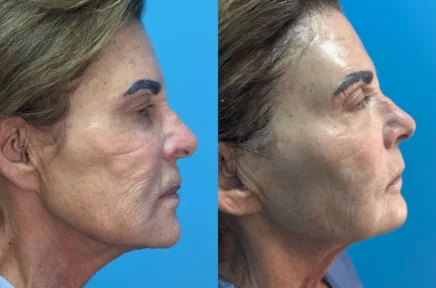 Side profile before and after comparison of woman's facial structure and contours
