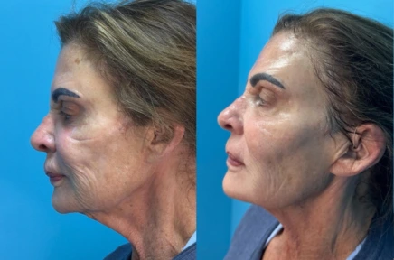 Side profile before and after comparison showing changes to woman's chin and jawline definition